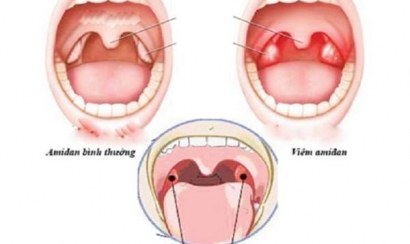 Tìm hiểu viêm amidan hốc mủ