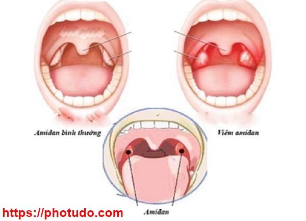 viêm amidan hốc mủ